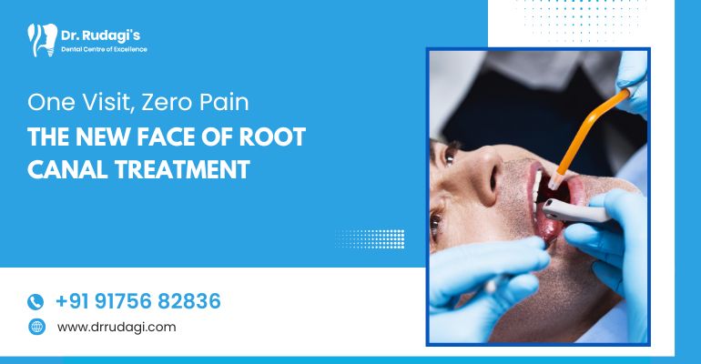 root canal
