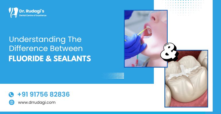Understanding The Difference Between Fluoride And Sealants