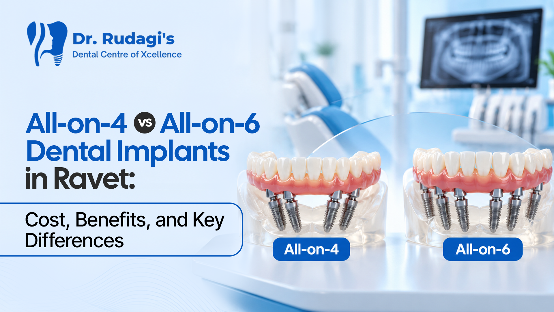 All-on-4 vs All-on-6 dental implants comparison in Ravet showing full arch implant treatment options