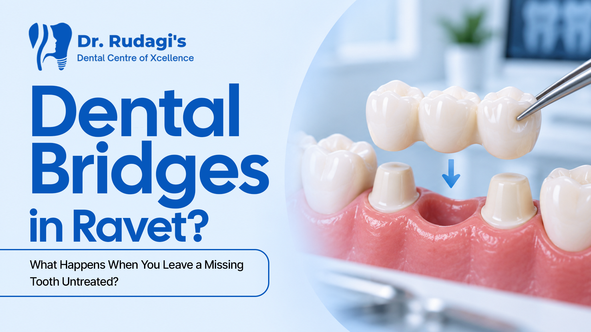 Dental bridge treatment for a missing tooth in Ravet