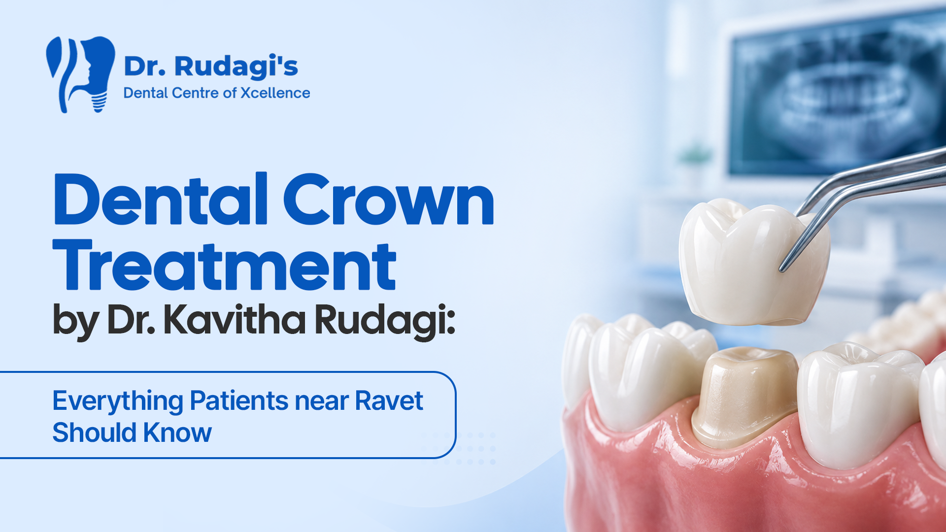 Dental Crown Treatment by Dr. Kavitha Rudagi: Everything Patients Near Ravet Should Know