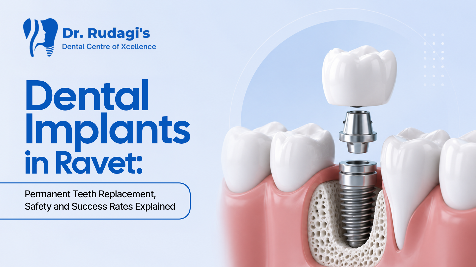 Dental implant treatment in Ravet