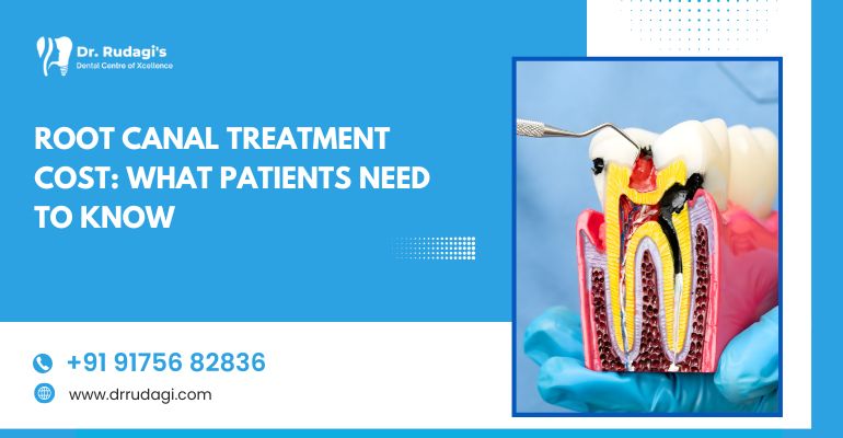Root Canal Treatment Cost: What Patients Need to Know?