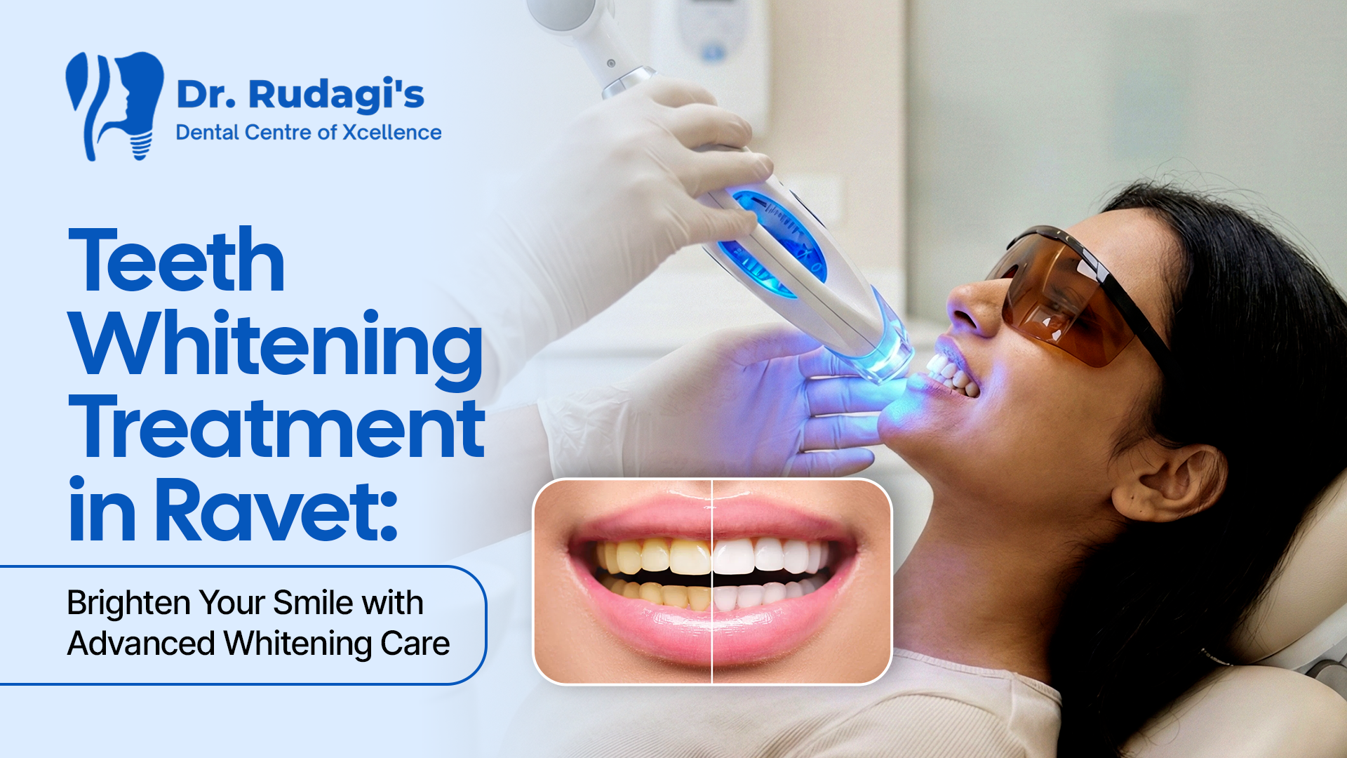 teeth whitening  treatment in Ravet